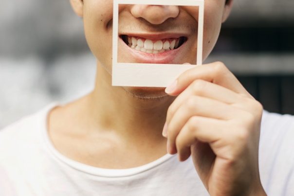 Smile Makeover Best Dental Implants in Hyderabad