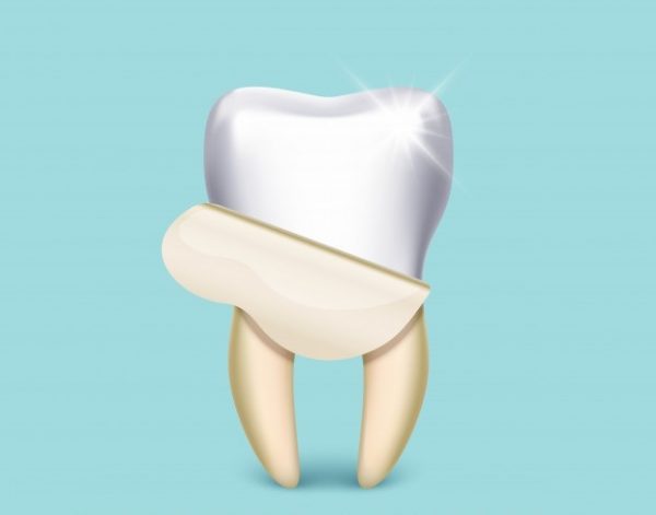 dental-veneer-featured Dental Veneers