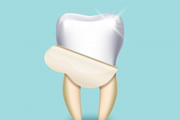 Dental Veneers