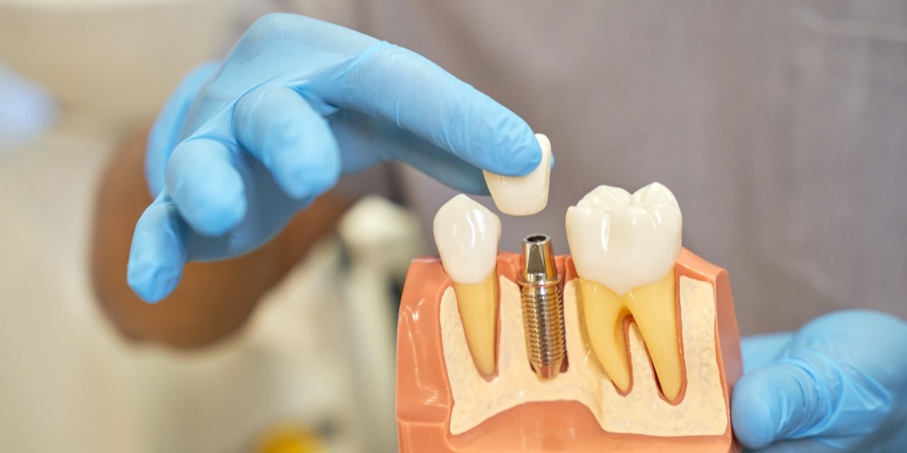 Types of Dental Implants Article Types of Dental Implants
