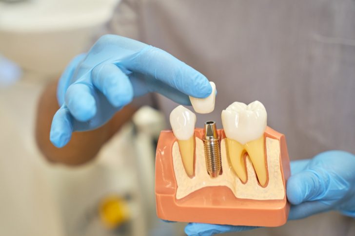 Types of Dental Implants