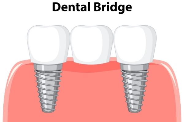 Bridges - Positive Dental