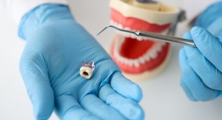 root canal on crowned tooth –