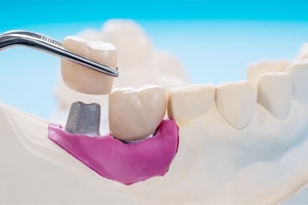 Bridges Vs Single Tooth Bridge - positivedental