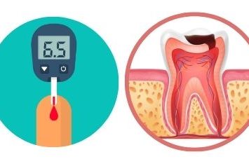 Dental Implants for Diabetics - Positivedental