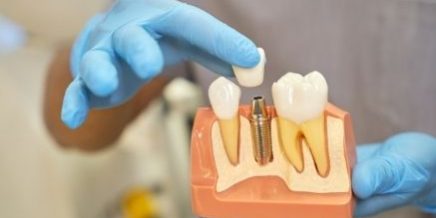 Dental Implants for Seniors — Positive Dental Dental Implants for Seniors -- Positive Dental
