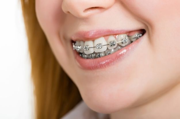 Overbite -Teeth Treatment - Positive Dental