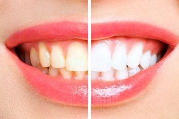 Tooth whitening and celebrities interlinked - Positive Dental
