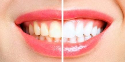Tooth whitening and celebrities interlinked – Positive Dental Tooth whitening and celebrities interlinked - Positive Dental