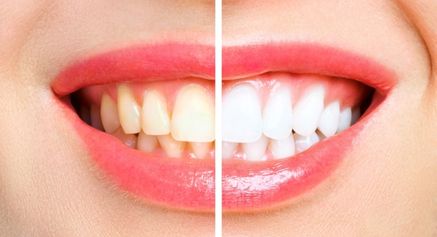 Tooth whitening and celebrities interlinked - Positive Dental